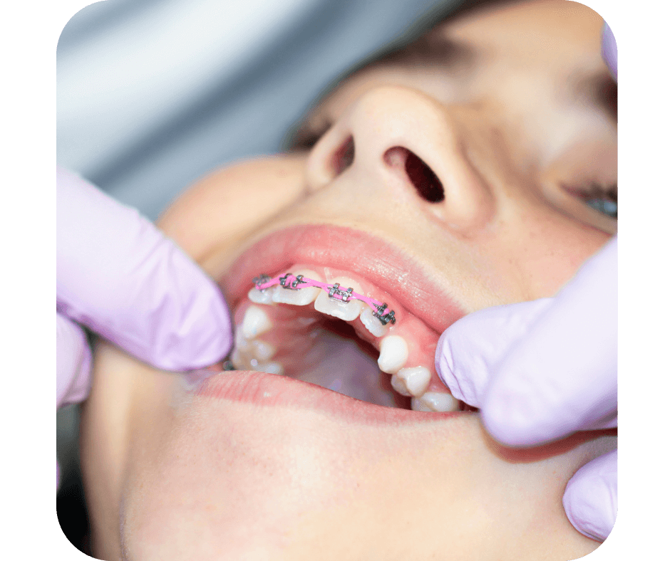 Early Orthodontic Treatment | The McLean Orthodontist